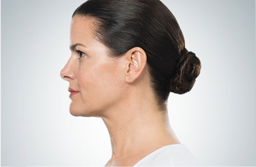 Kybella | Kybella Near Me | What is Kybella® and how it can help you?