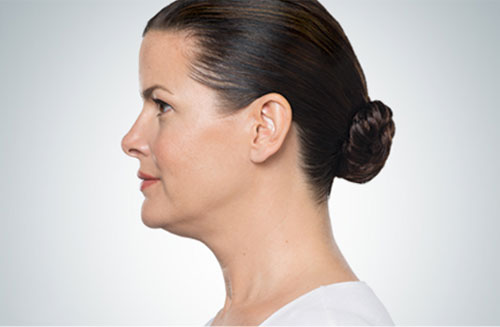 Kybella | Kybella Near Me | What is Kybella® and how it can help you?